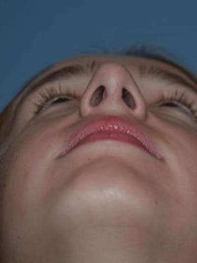Rhinoplasty Before & After Gallery - Patient 173624258 - Image 8