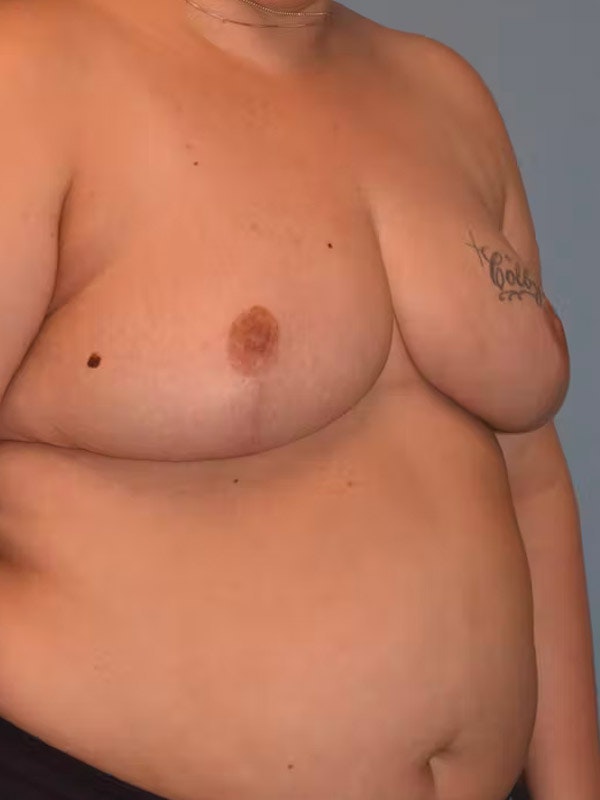 Breast Reduction Before & After Gallery - Patient 173624261 - Image 4