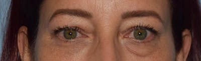 Eyelid Lift Before & After Gallery - Patient 173624265 - Image 1