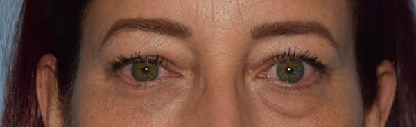 Eyelid Lift Before & After Gallery - Patient 173624265 - Image 1