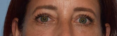 Eyelid Lift Before & After Gallery - Patient 173624265 - Image 2