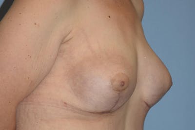 Breast Reconstruction Before & After Gallery - Patient 173624264 - Image 6