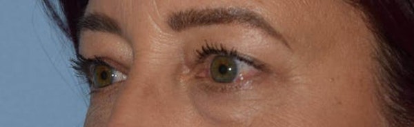 Eyelid Lift Before & After Gallery - Patient 173624265 - Image 3