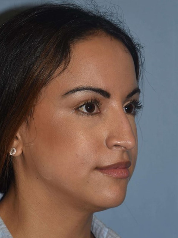 Rhinoplasty Before & After Gallery - Patient 173624266 - Image 3