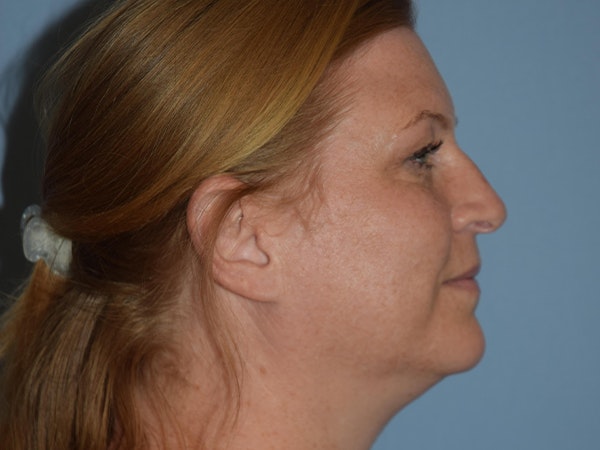 Facial Fat Grafting Before & After Gallery - Patient 173624263 - Image 5