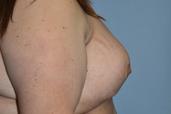 Breast Reconstruction Before & After Gallery - Patient 173624264 - Image 7