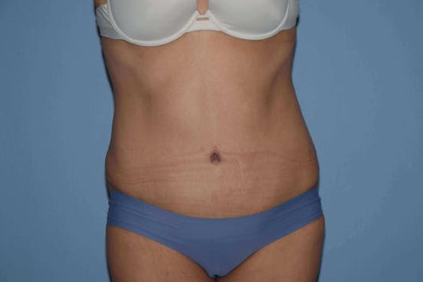 Tummy Tuck Before & After Gallery - Patient 173624271 - Image 2