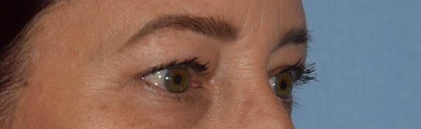 Eyelid Lift Before & After Gallery - Patient 173624265 - Image 5