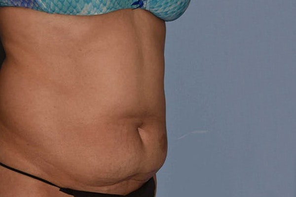 Tummy Tuck Before & After Gallery - Patient 173624271 - Image 3