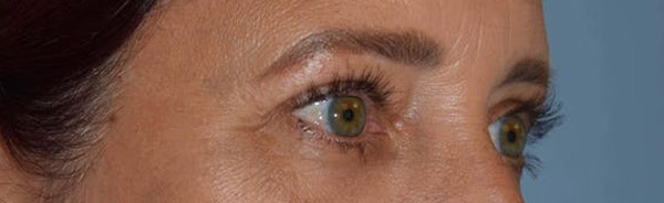 Eyelid Lift Before & After Gallery - Patient 173624265 - Image 6