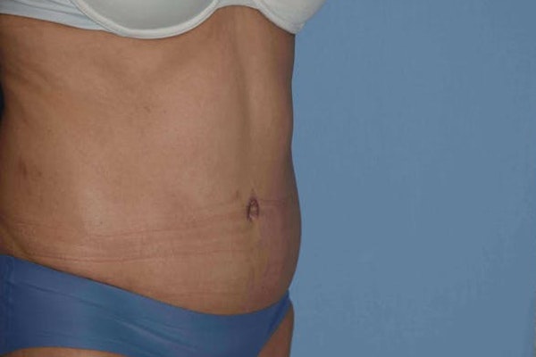 Tummy Tuck Before & After Gallery - Patient 173624271 - Image 4