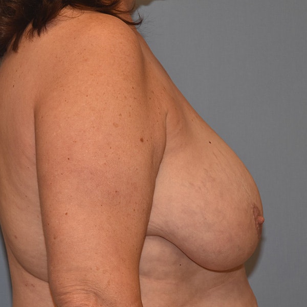 Breast Reduction Before & After Gallery - Patient 173624272 - Image 5