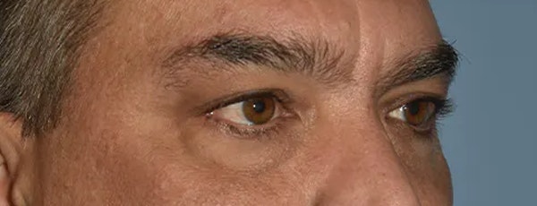 Eyelid Lift Before & After Gallery - Patient 173624275 - Image 3
