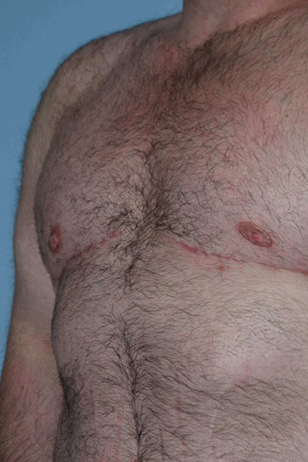 Gynecomastia Before & After Gallery - Patient 173624274 - Image 6