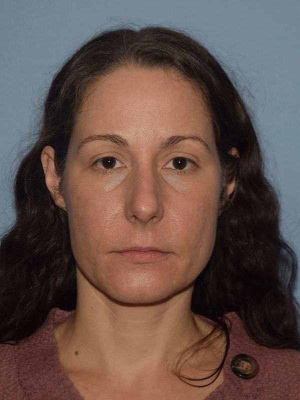 Rhinoplasty Before & After Gallery - Patient 173624278 - Image 5