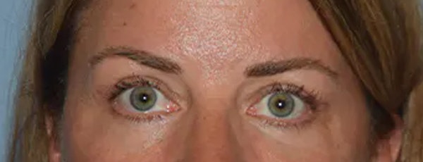 Eyelid Lift Before & After Gallery - Patient 173624305 - Image 2