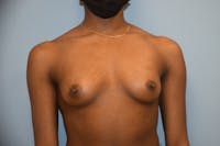 Breast Augmentation Before & After Gallery - Patient 173624329 - Image 1