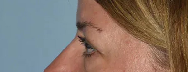Eyelid Lift Before & After Gallery - Patient 173624305 - Image 5