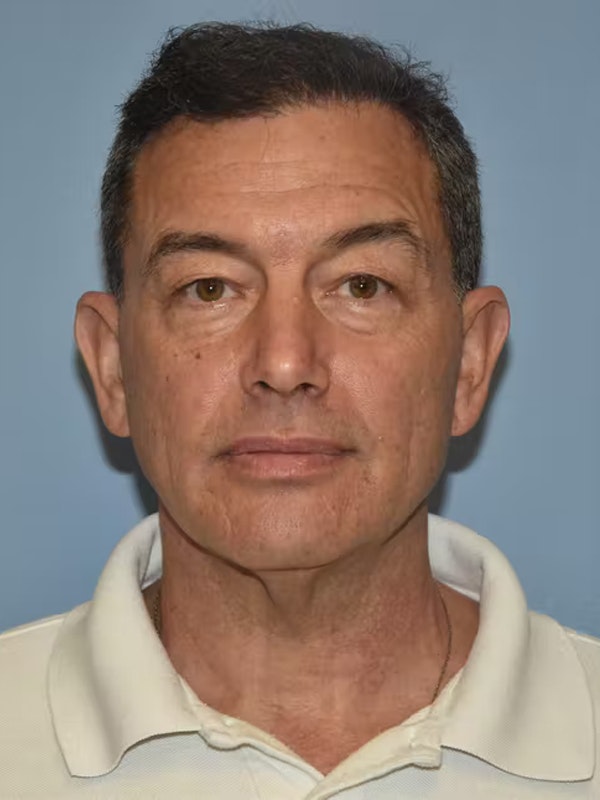 Facelift Before & After Gallery - Patient 173624310 - Image 1