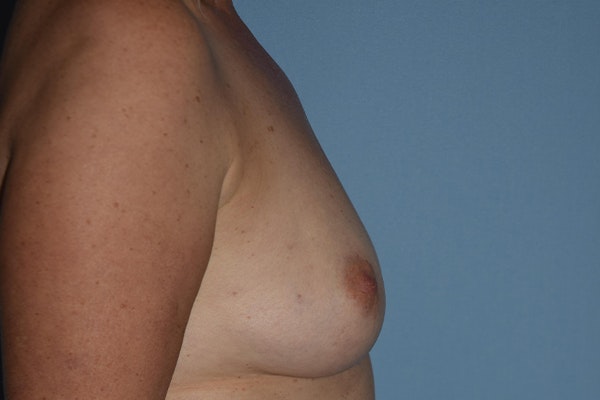Breast Reconstruction Before & After Gallery - Patient 173624303 - Image 9