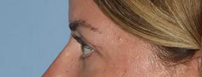 Eyelid Lift Before & After Gallery - Patient 173624305 - Image 6