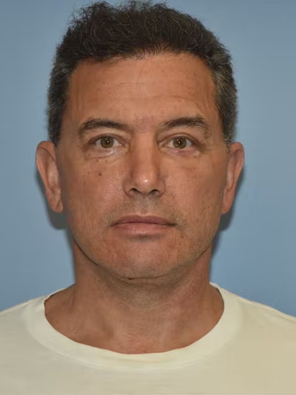 Facelift Before & After Gallery - Patient 173624310 - Image 2
