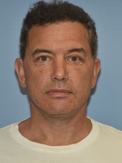 Facelift Before & After Gallery - Patient 173624310 - Image 2