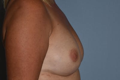 Breast Reconstruction Before & After Gallery - Patient 173624303 - Image 10