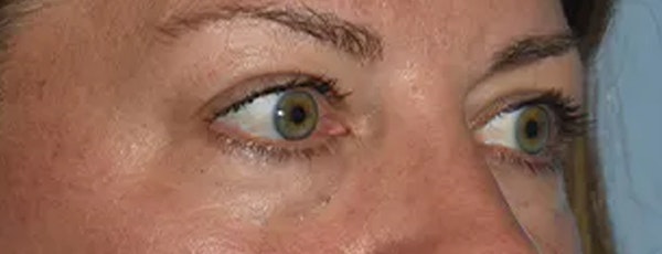 Eyelid Lift Before & After Gallery - Patient 173624305 - Image 7