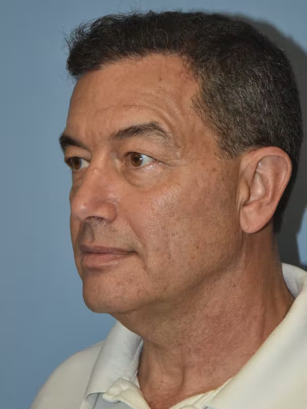 Facelift Before & After Gallery - Patient 173624310 - Image 3