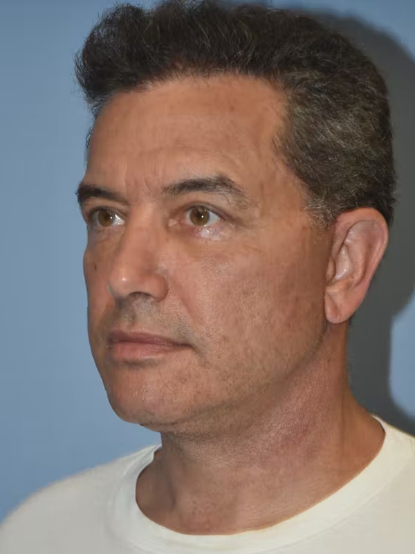 Facelift Before & After Gallery - Patient 173624310 - Image 4