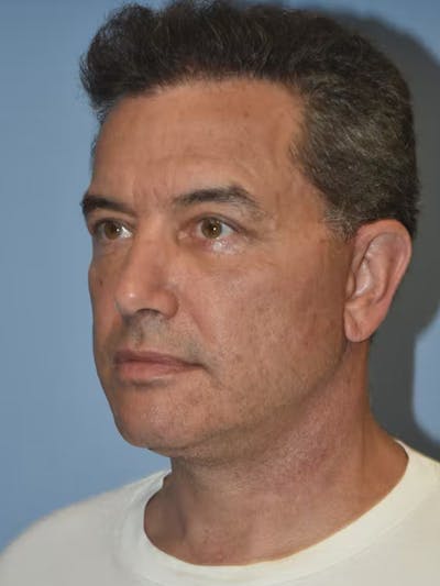 Facelift Before & After Gallery - Patient 173624310 - Image 4