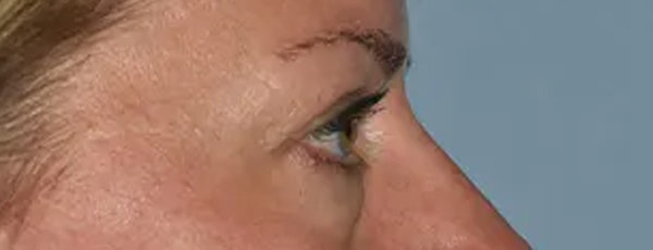 Eyelid Lift Before & After Gallery - Patient 173624305 - Image 9
