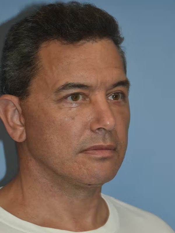 Facelift Before & After Gallery - Patient 173624310 - Image 6