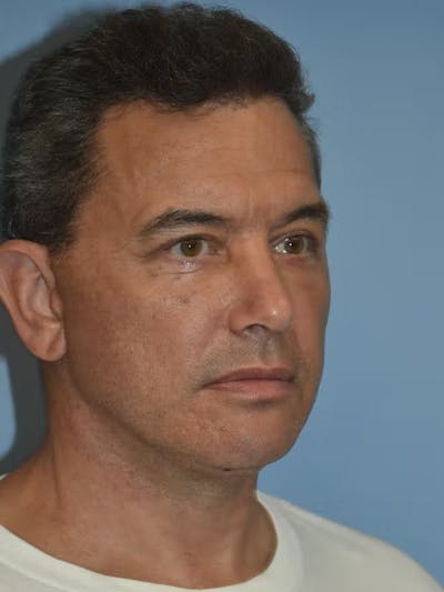 Facelift Before & After Gallery - Patient 173624310 - Image 6