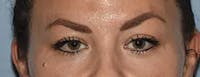 Eyelid Lift Before & After Gallery - Patient 173624312 - Image 1