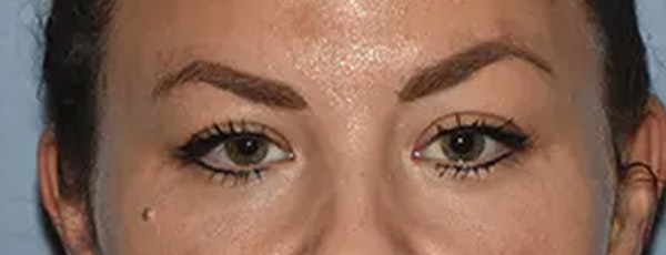 Eyelid Lift Before & After Gallery - Patient 173624312 - Image 1