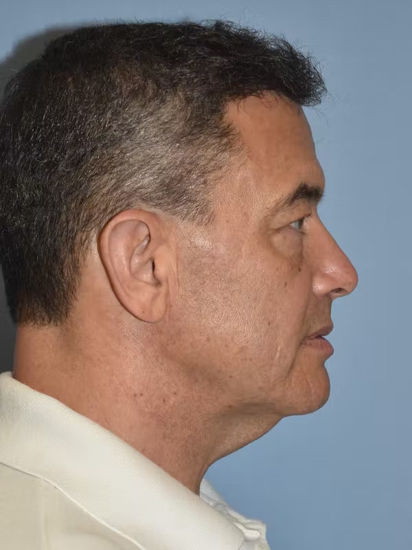 Facelift Before & After Gallery - Patient 173624310 - Image 7