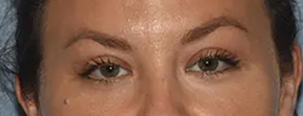 Eyelid Lift Before & After Gallery - Patient 173624312 - Image 2