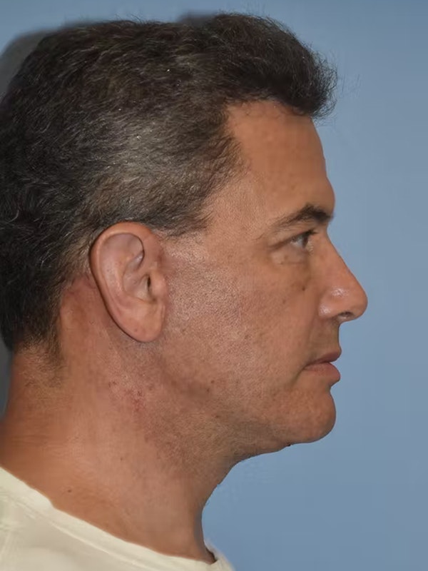 Facelift Before & After Gallery - Patient 173624310 - Image 8