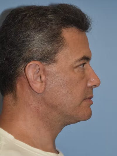 Facelift Before & After Gallery - Patient 173624310 - Image 8