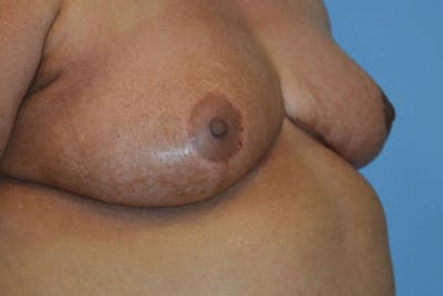 Breast Reconstruction Before & After Gallery - Patient 173624315 - Image 2
