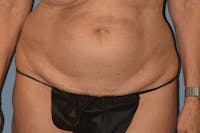 Tummy Tuck Before & After Gallery - Patient 173624316 - Image 1