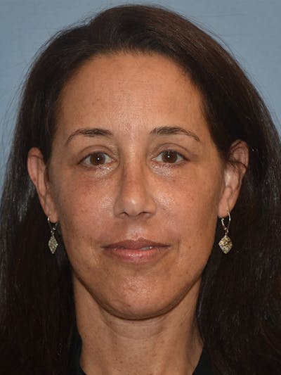 Facelift Before & After Gallery - Patient 173624319 - Image 2