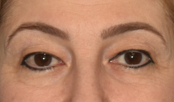 Eyelid Lift Before & After Gallery - Patient 173624320 - Image 1
