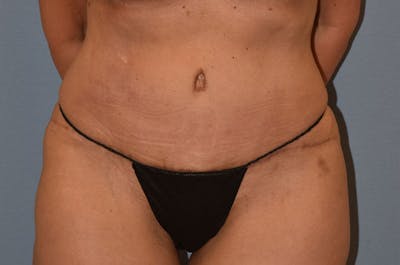 Tummy Tuck Before & After Gallery - Patient 173624316 - Image 2