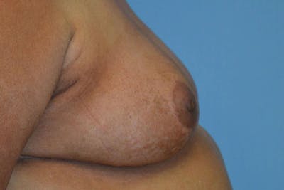 Breast Reconstruction Before & After Gallery - Patient 173624315 - Image 4