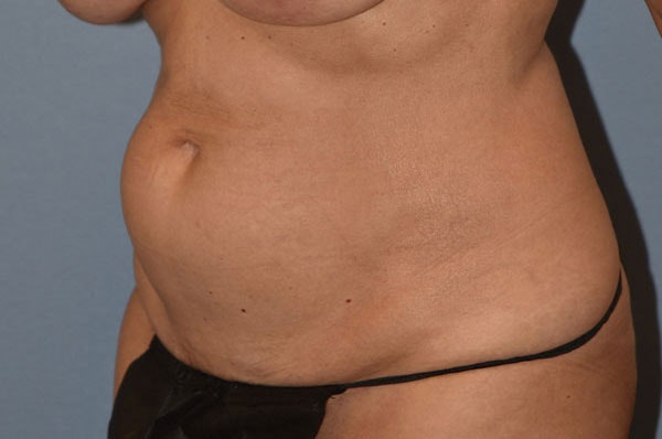 Tummy Tuck Before & After Gallery - Patient 173624316 - Image 3