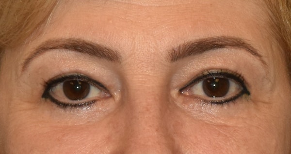Eyelid Lift Before & After Gallery - Patient 173624320 - Image 2