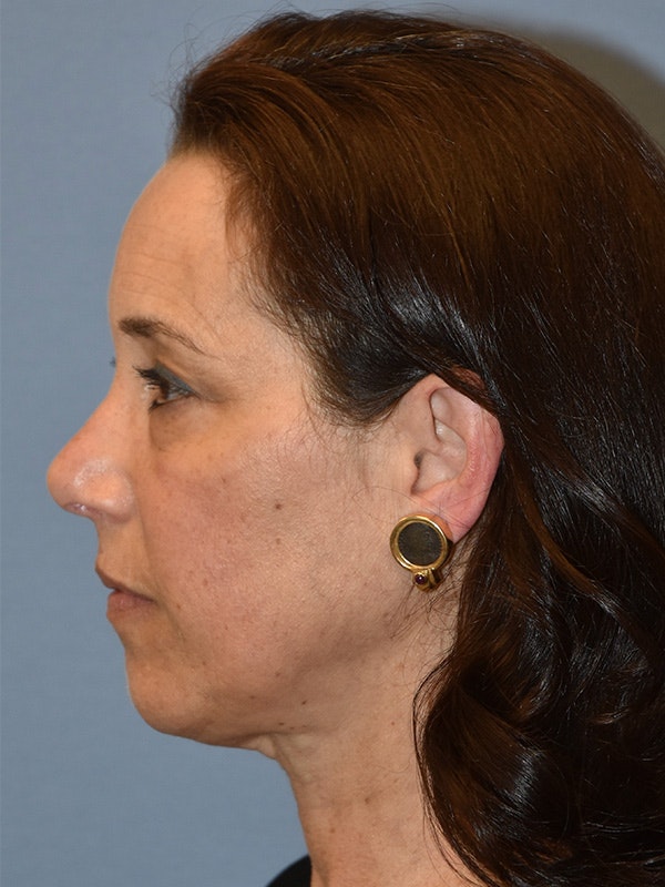 Facelift Before & After Gallery - Patient 173624319 - Image 5